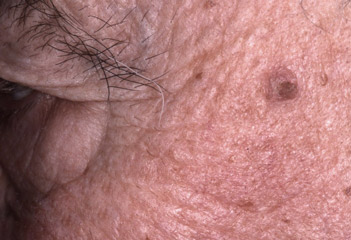 Υπερκερατωτική βλάβη