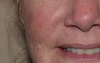 Βλάβες ακτινικής κεράτωσης